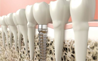 Estabilidad primaria en los tratamientos de implantes dentales