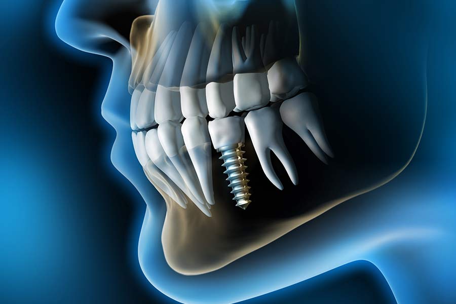 fracaso-de-implantes-dentales-vitoria-bustillo-lopez