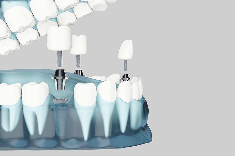 implantes-dentales-vitoria-bustillo-lopez