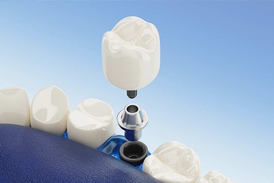 protesis-sobre-implantes