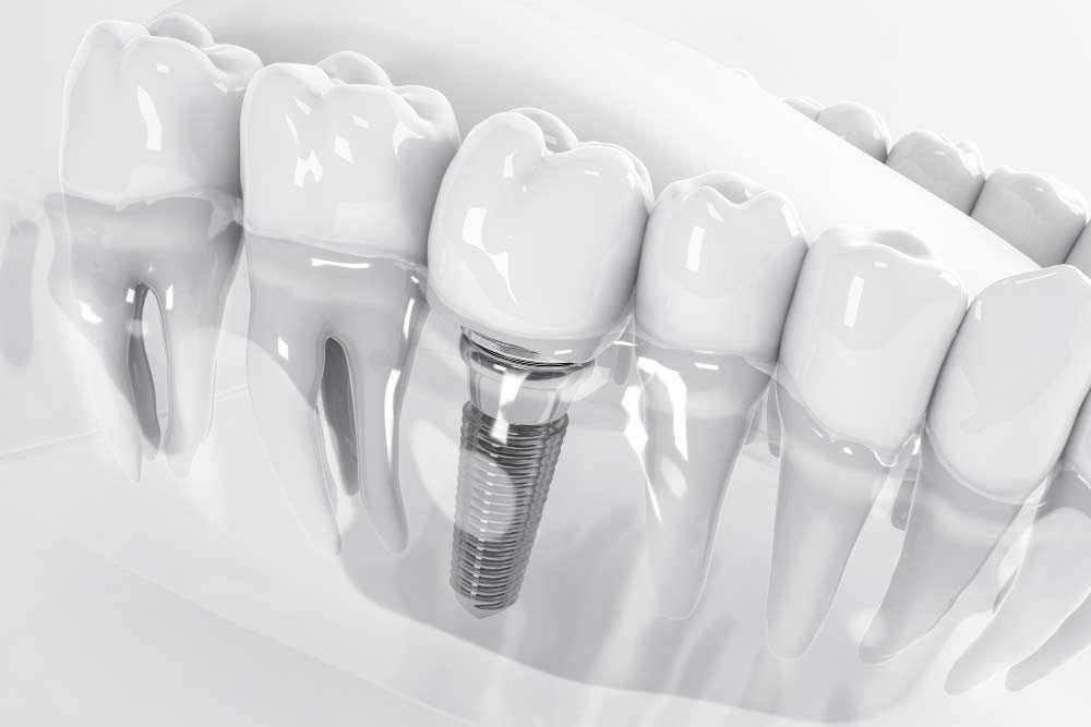 Implante dental: Todo lo que necesitas saber para una sonrisa perfecta