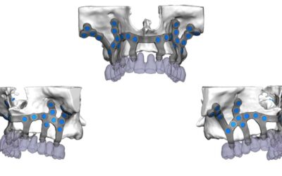 Los implantes dentales subperiósticos.
